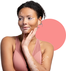 tratamientos_0014_vitiligo