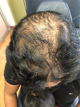 alopecia 1a