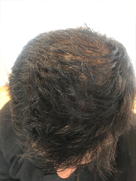 alopecia 1d