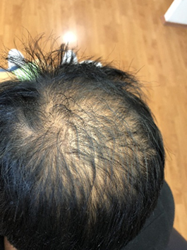 alopecia 2a