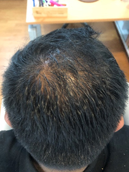 alopecia 2d