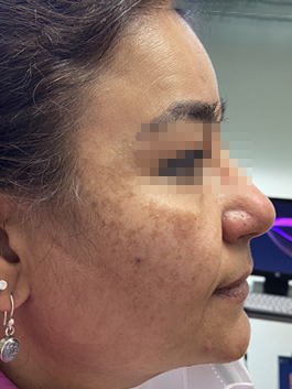 melasma1