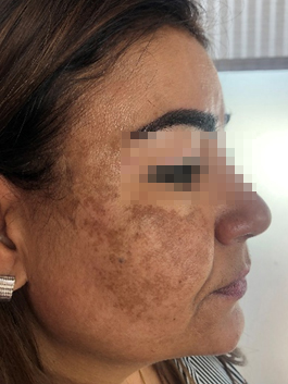 melasma1a