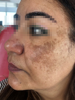 melasma2a