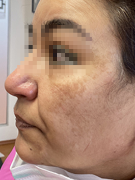 melasma2d