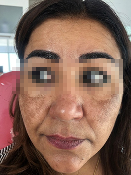 melasma3a