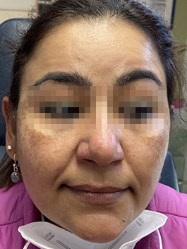 melasma3d